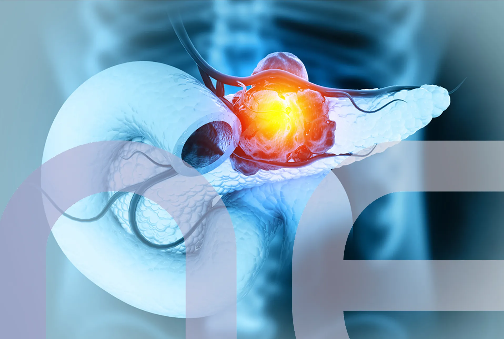 Pancreas-cancer