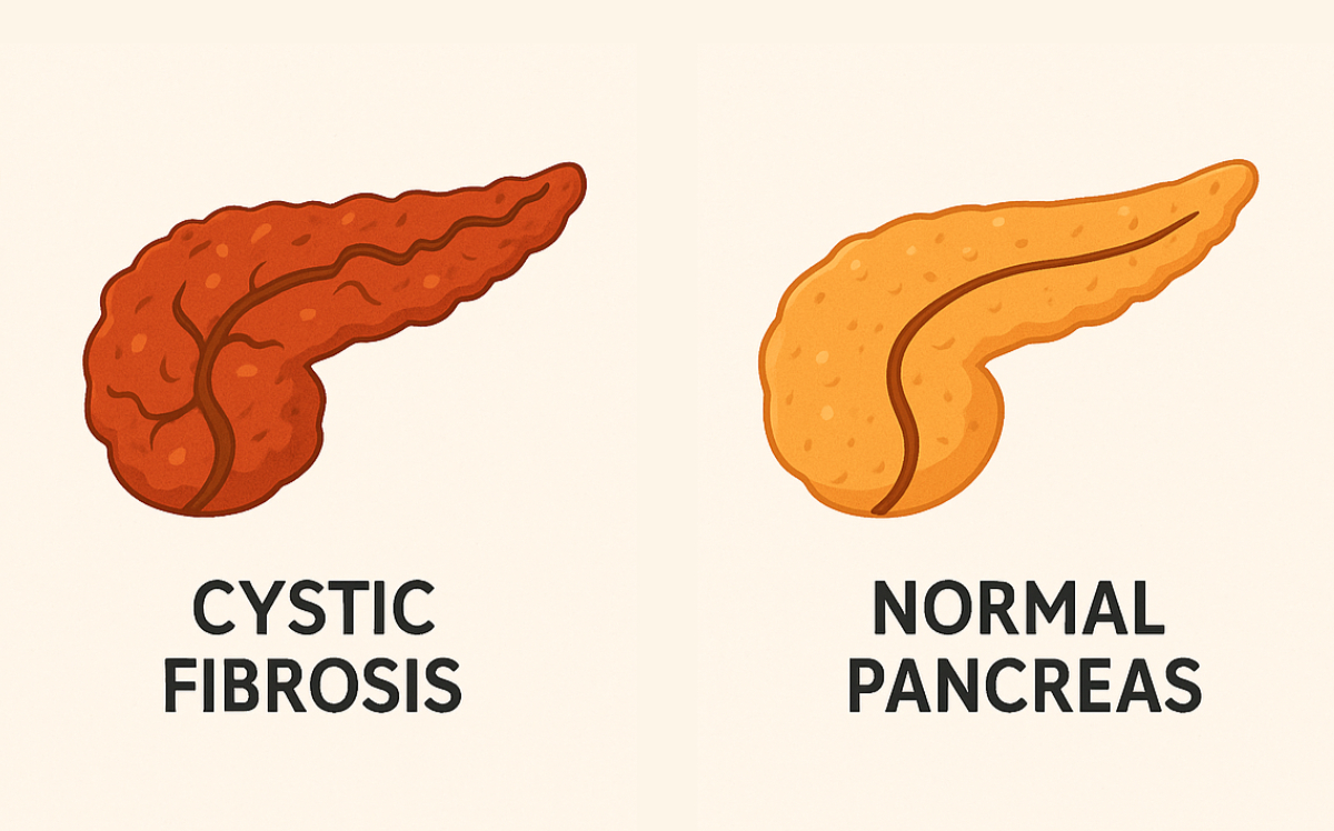 Cystic fibrosis and pancreatic function